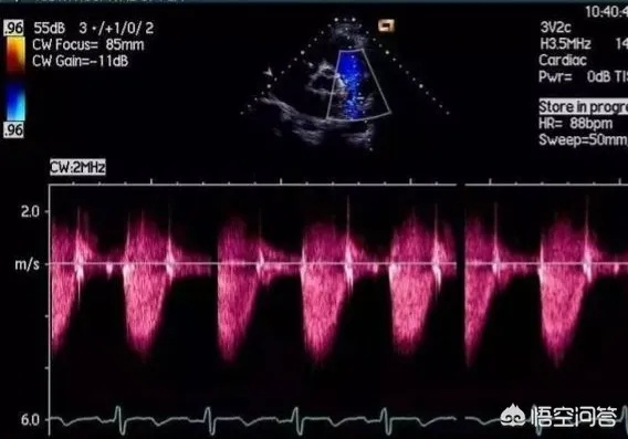 太平洋在线注册官网：心脏彩超中 了解心脏彩超检查的作用和过程-第2张图片-www.211178.com_果博福布斯