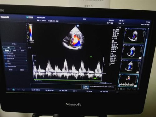 太平洋在线注册官网：心脏彩超中 了解心脏彩超检查的作用和过程-第3张图片-www.211178.com_果博福布斯